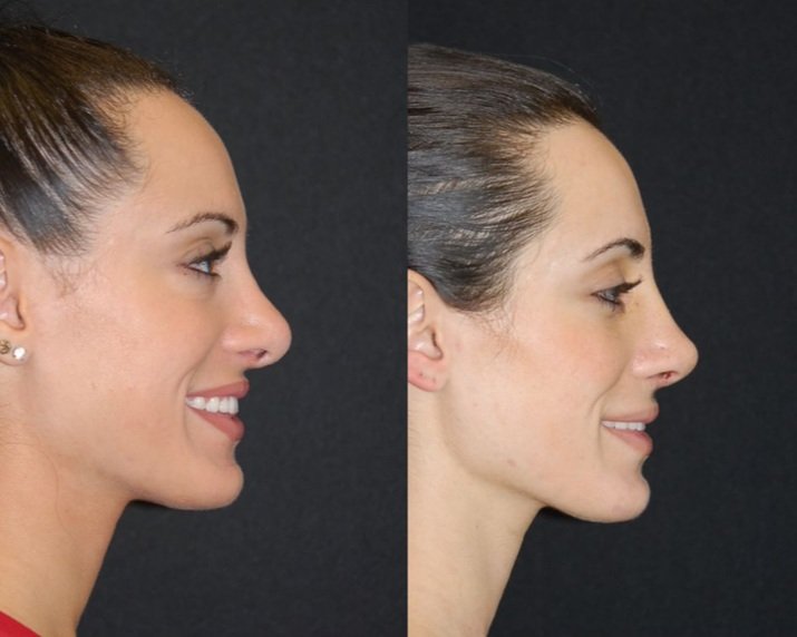 Three months after Before and After  Revision Rhinoplasty