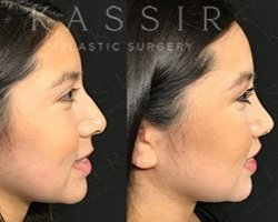 1 month after Ethnic Revision Rhinoplasty and Lip Lift