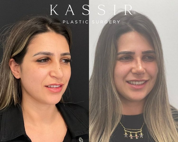 Before and After Revision Rhinoplasty