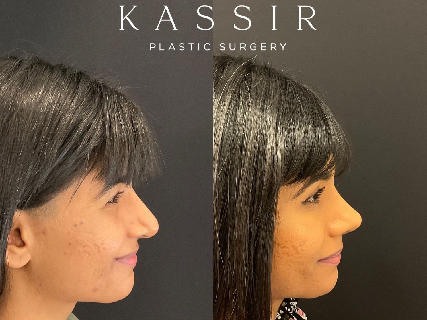 6months After Ethnic Revision Rhinoplasty