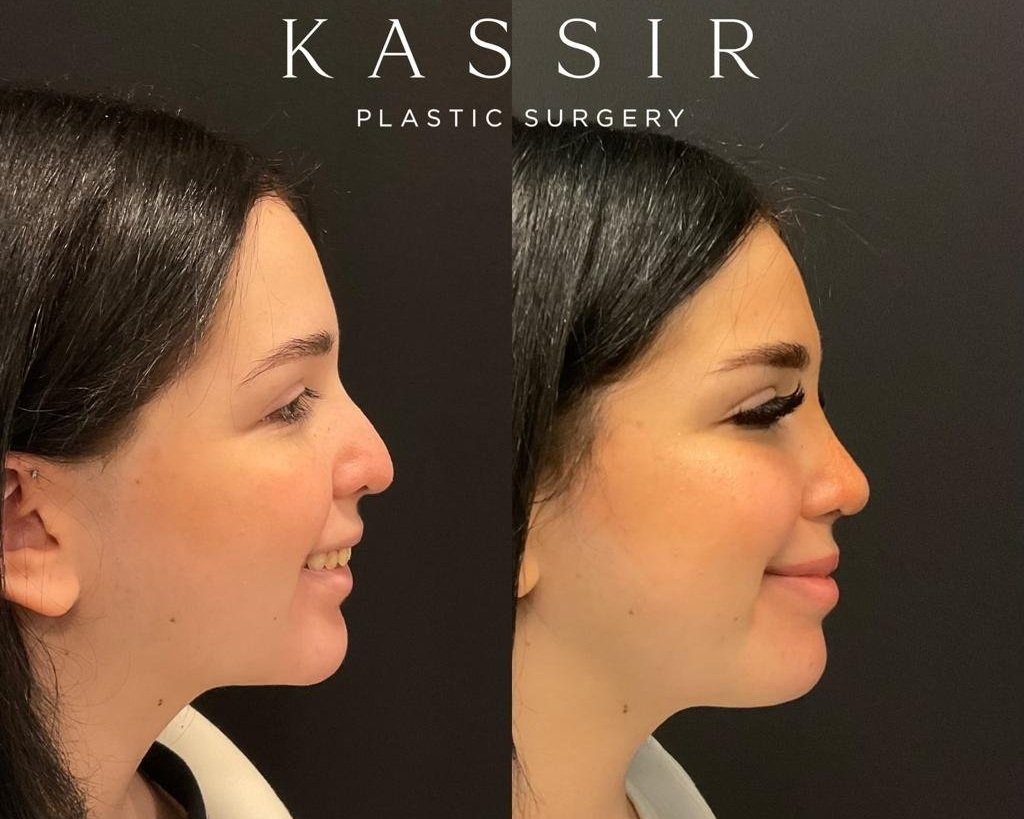 6 months after Complex Revision Nose Job