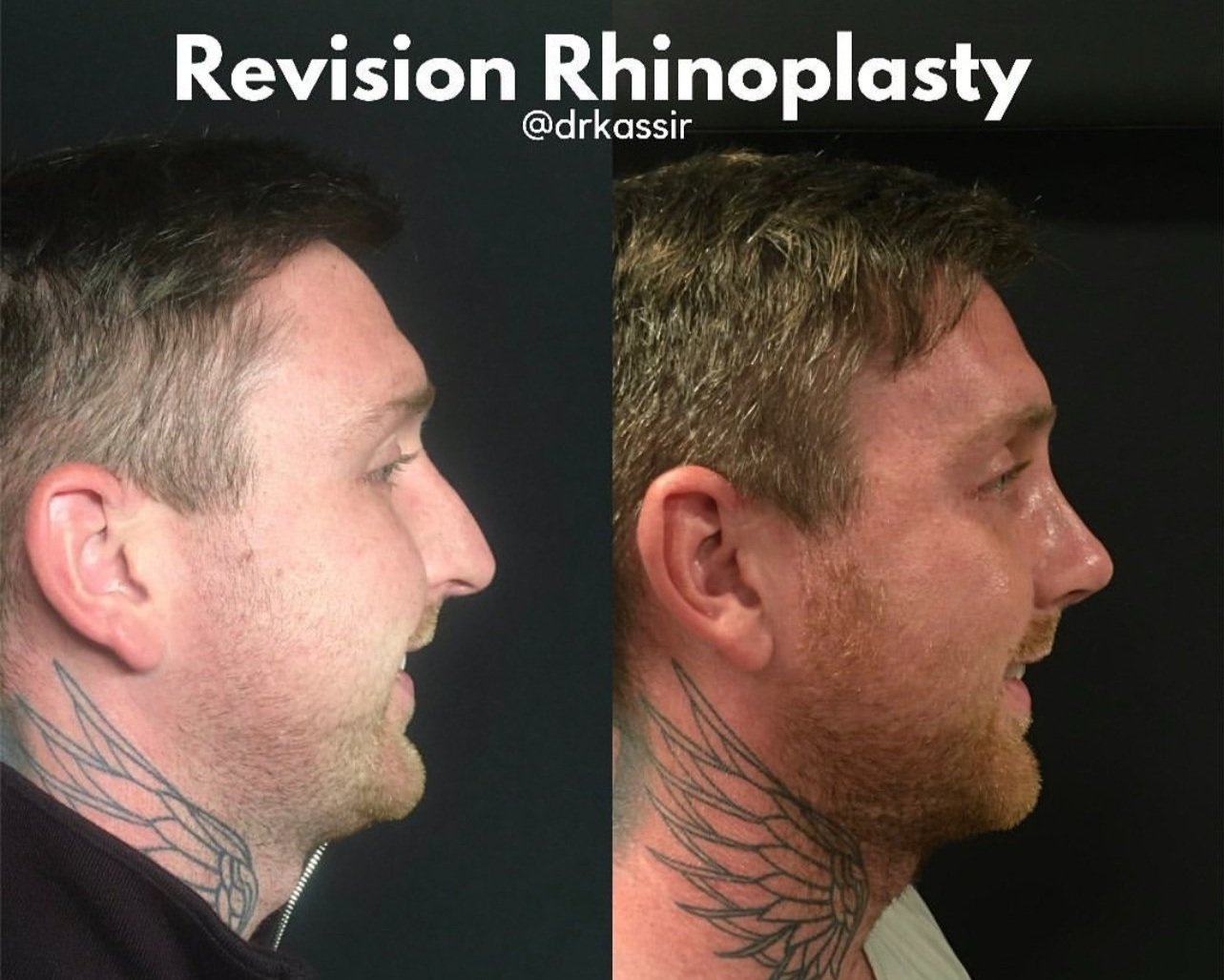Male Revision Rhinoplasty Before and After