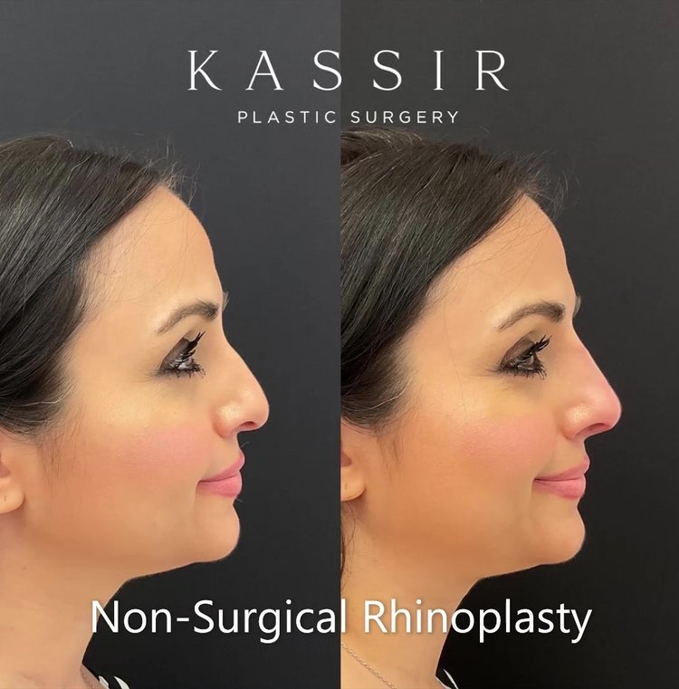 Female Non Surgical Rhinoplasty Patient Before and After