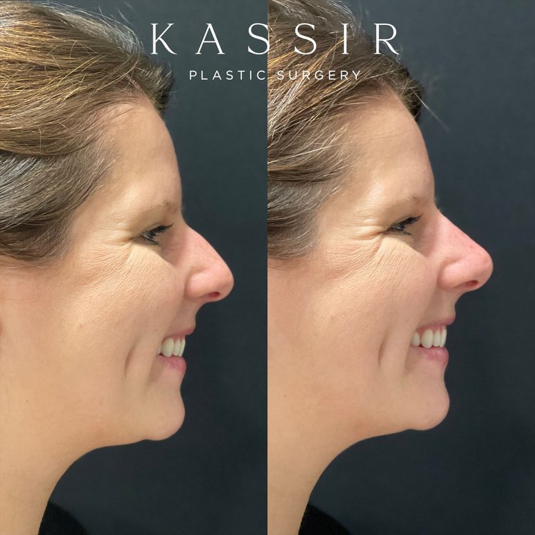  Female patient with high dorsum and slight convexity. WIth a liquid rhinoplasty we were able to straighten her side profile and give her a more elegant nose.  