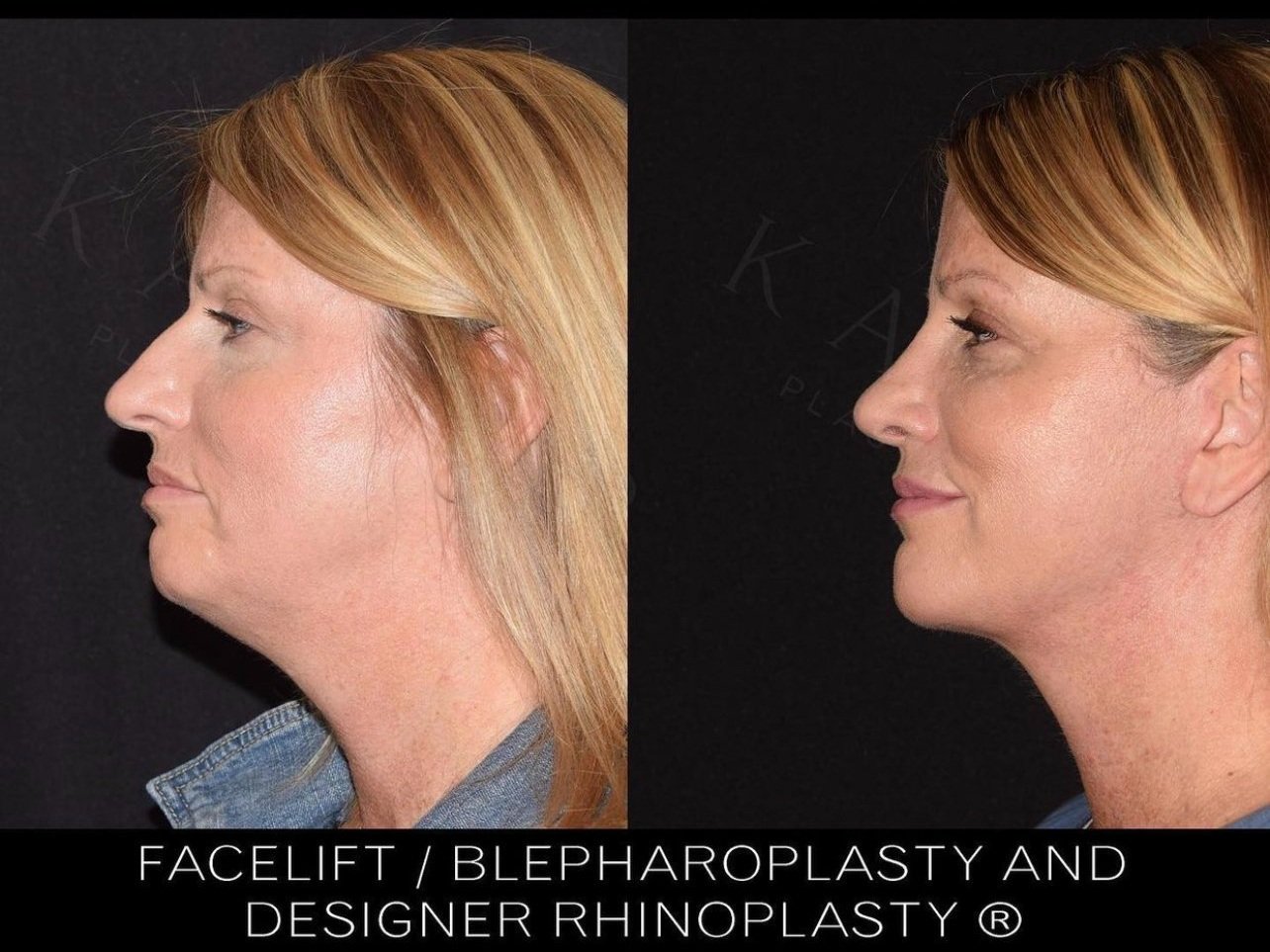 6 months after Facelift, Neck lift , Blepharoplasty and Designer Rhinoplasty®️ by Dr. Kassir