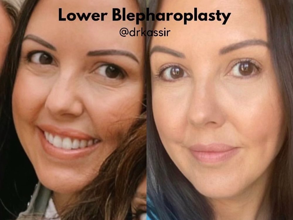 Eyelid Lift I Blepharoplasty Before And After Kassir Plastic blepharoplasty-center-for-eyecare