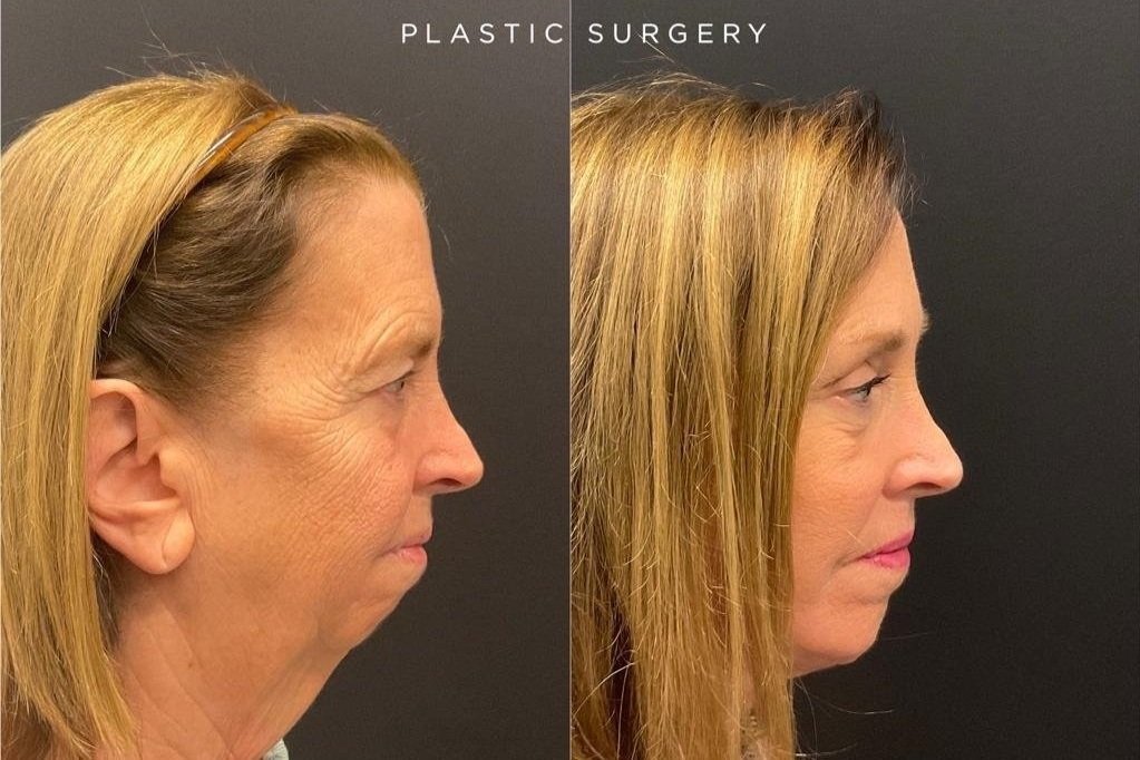 facelift%2B11-18%2B5.jpg