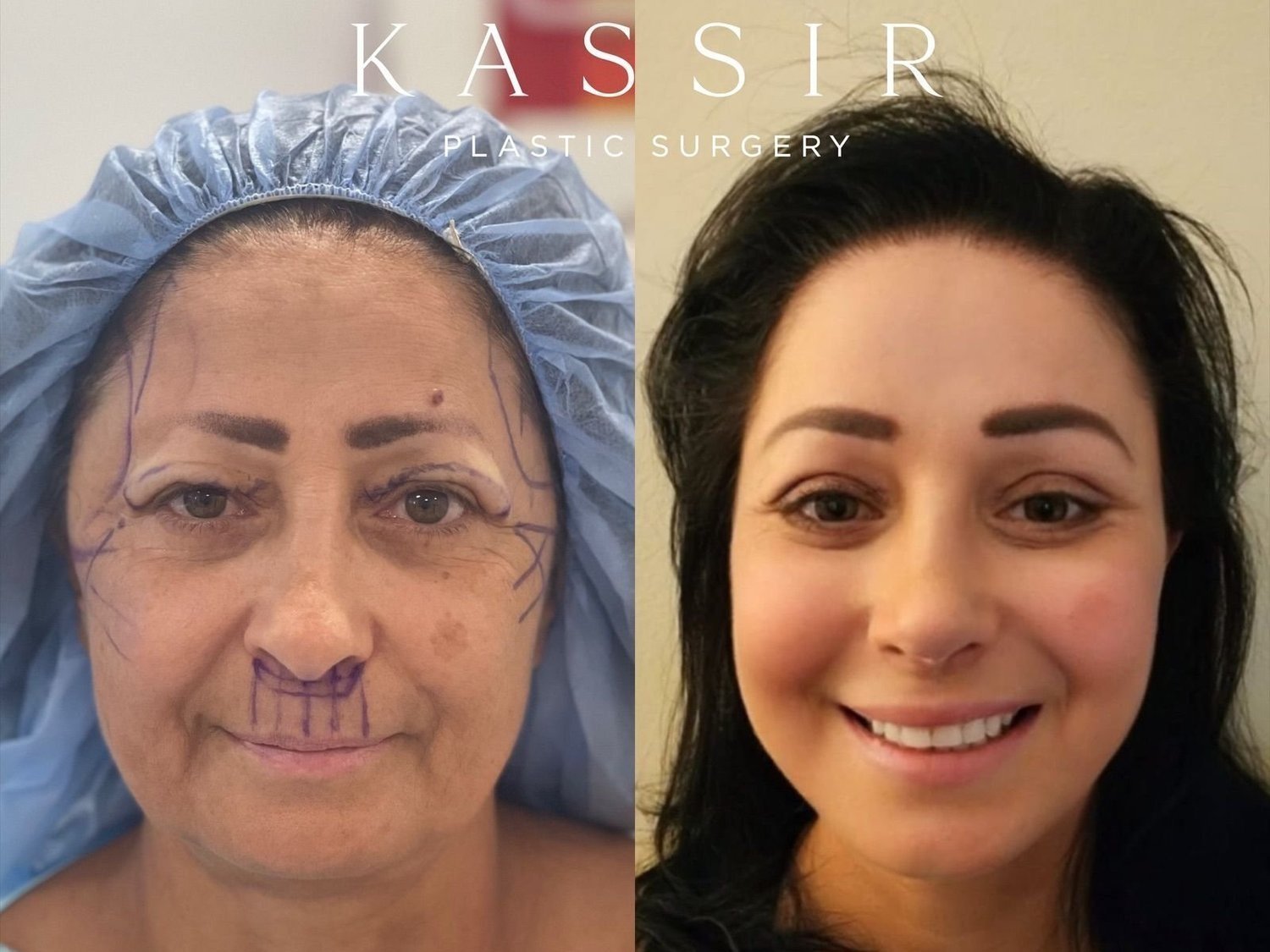 Facelift before and after