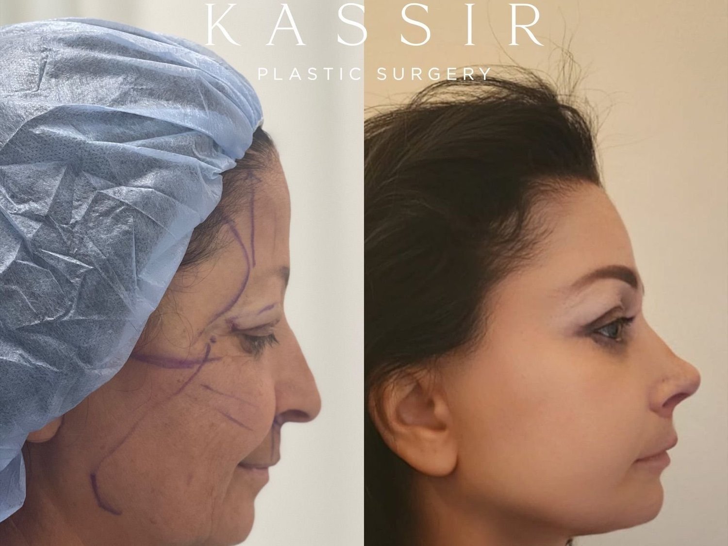 Facelift with rhinoplasty before and after