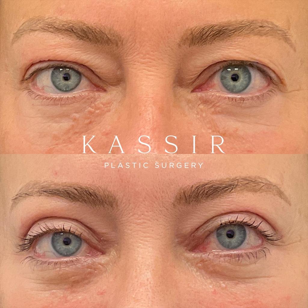 Blepharoplasty / Eyelid Surgery — Kassir Plastic Surgery in NY and NJ