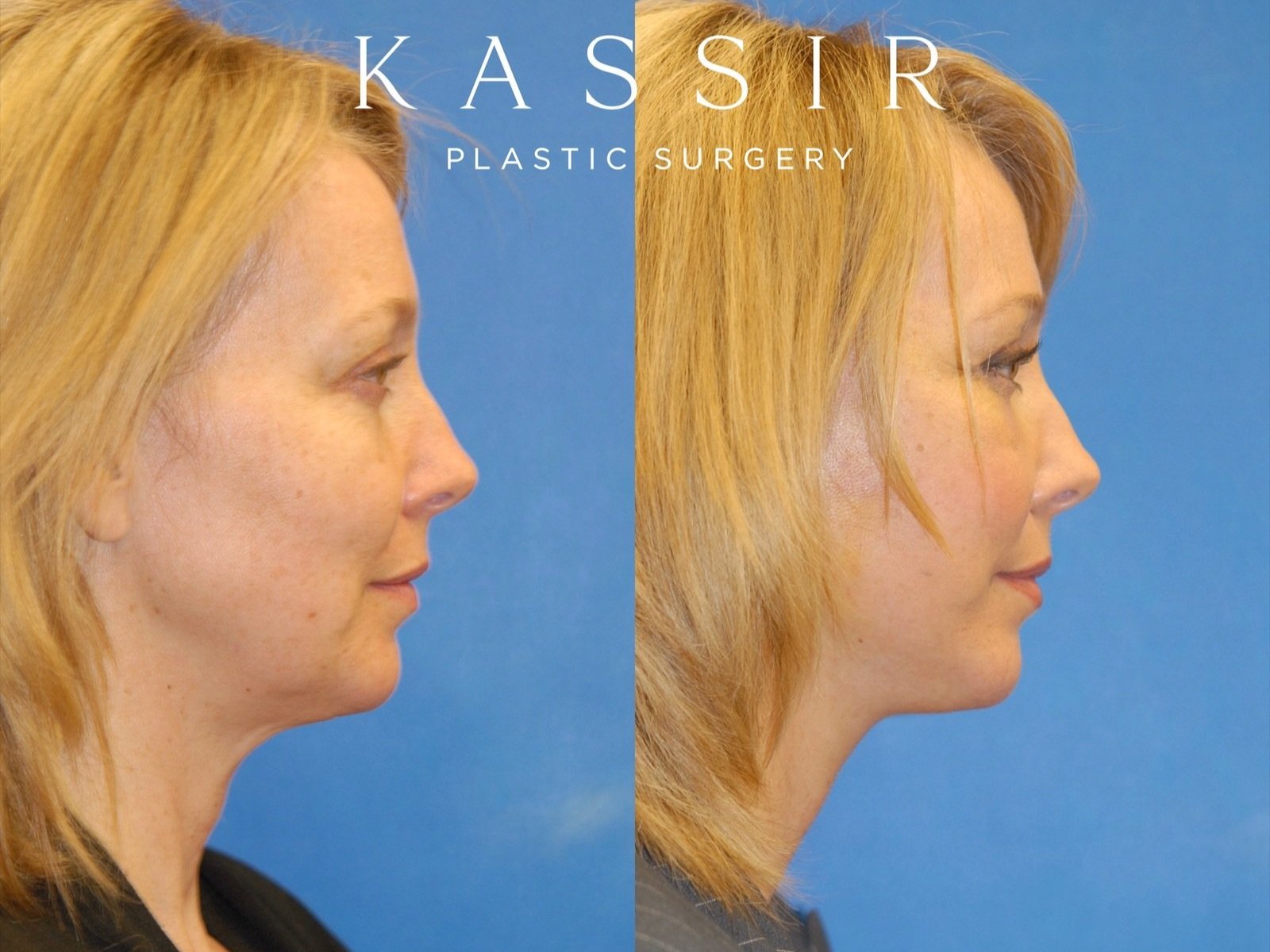 facelift+right+side+up+view+12-22-2022.jpg