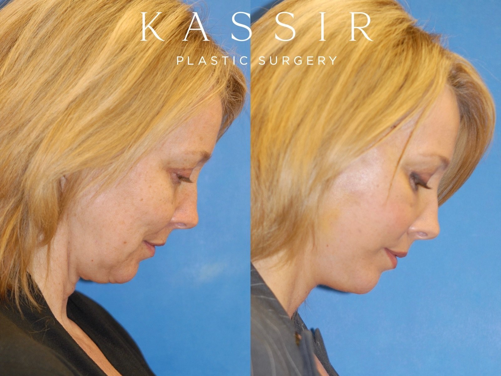 facelift+side+view+right+side+down+12-22-2022.jpg