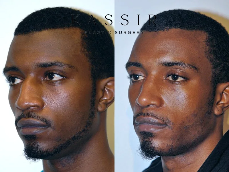 Ethnic Rhinoplasty / Black Male Rhinoplasty — Kassir Plastic Surgery in
