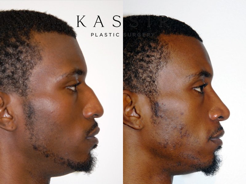 6 Months After Black Male Rhinoplasty