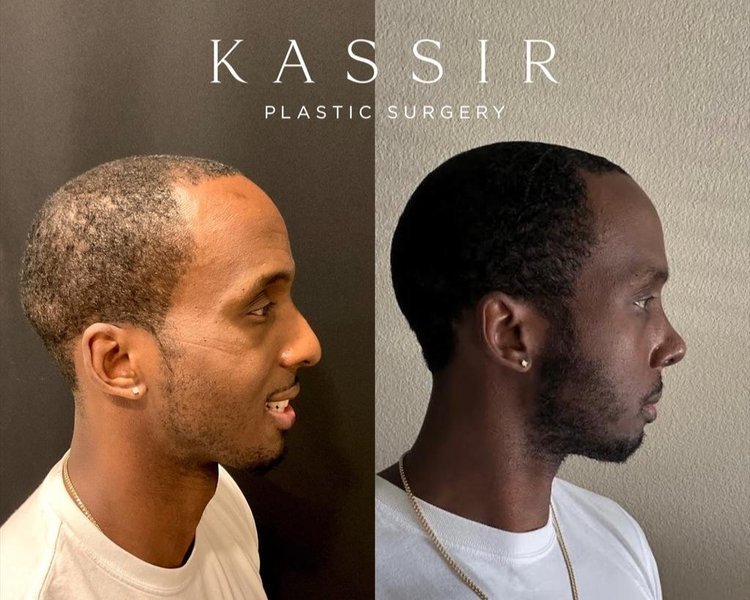 Before and After Black Male Rhinoplasty