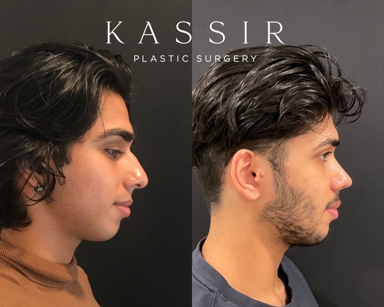 Before and After Male Ethnic Rhinoplasty