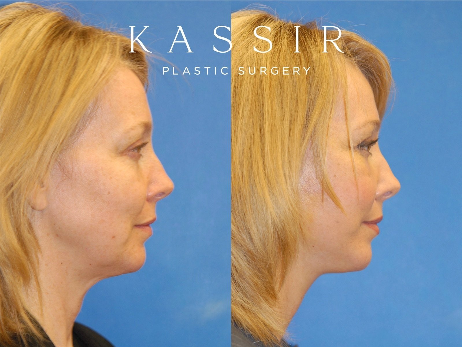 facelift+right+side+up+view+12-22-2022.jpg
