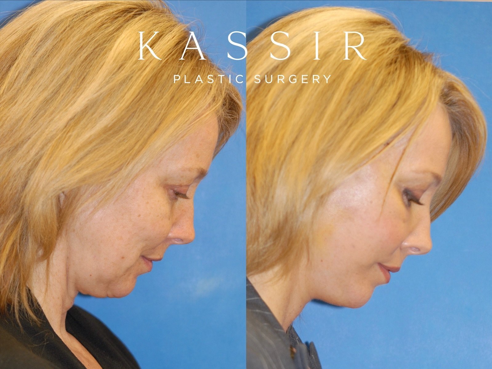 facelift+side+view+right+side+down+12-22-2022.jpg