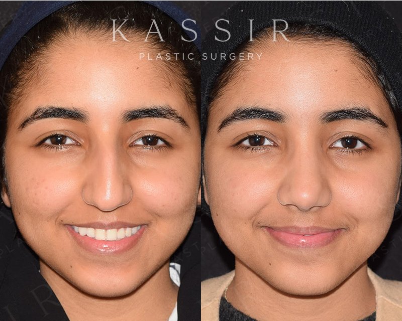 Before and After Facelifts. All healing stages and tips for a quick  recovery — Kassir Plastic Surgery in NY and NJ
