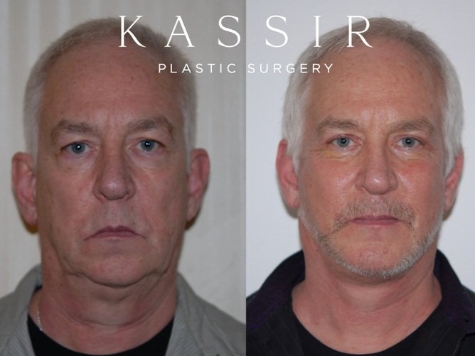 Best Male Facelift Before and After