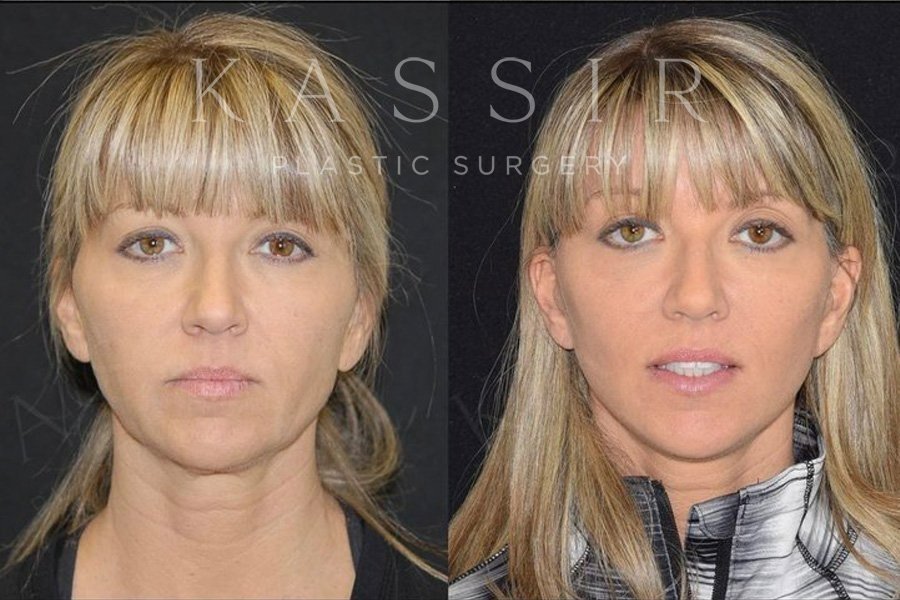 One year after facelift surgery