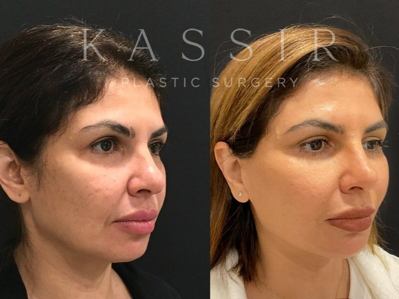 Face Lift Before and After Oblique View