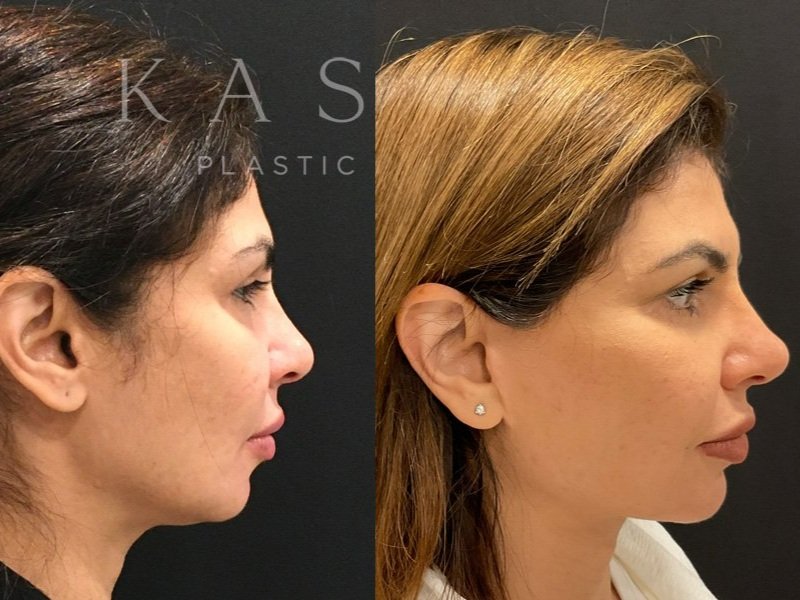 Face Lift Before and After Side view