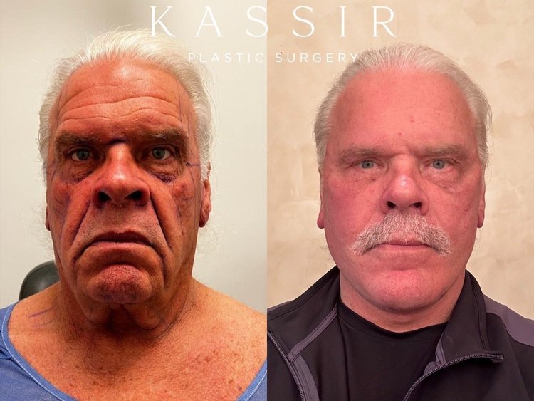 Before and after Male Deep Plane Facelift