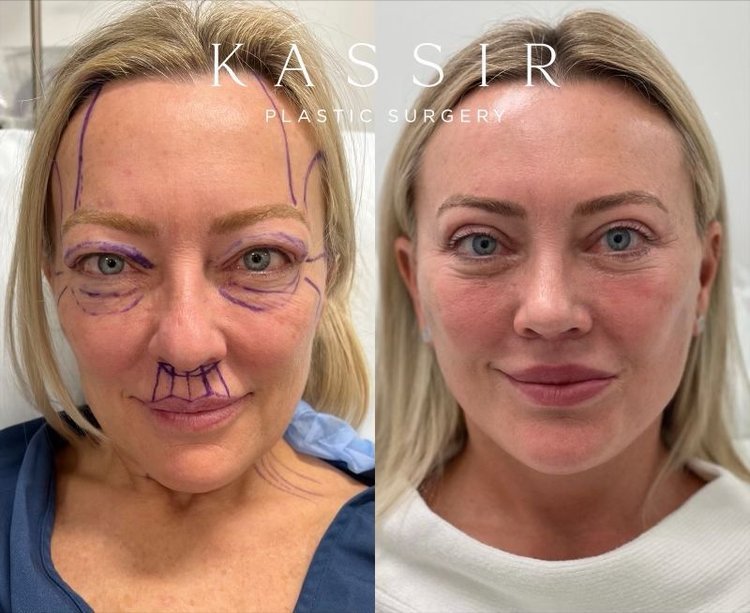 Facelift before and after