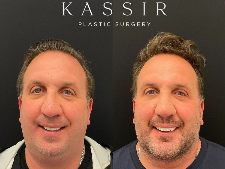 One week after Scarless Suture Suspension Male Face Lift NYC