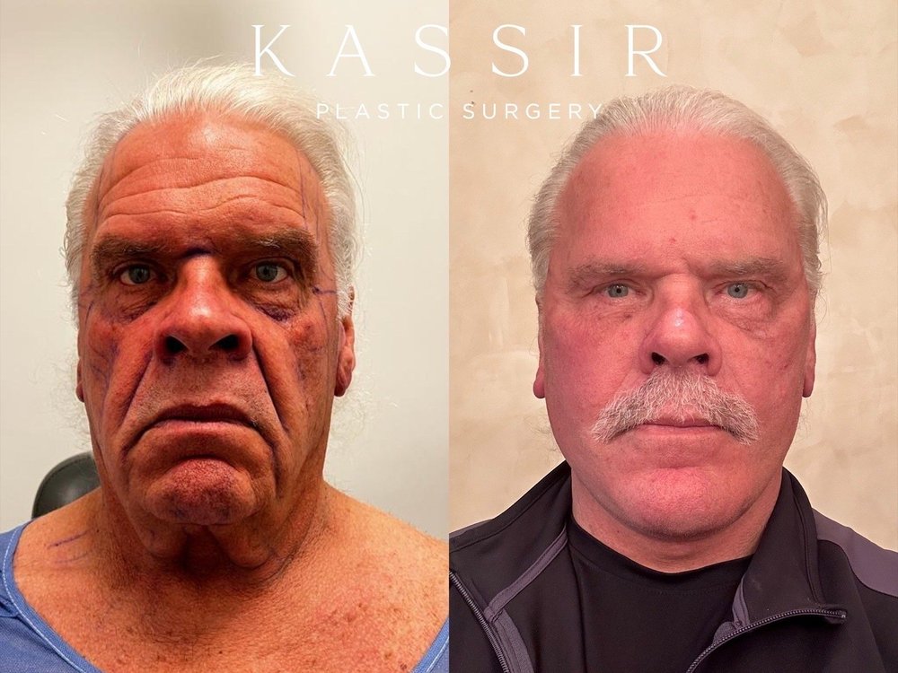 before and after plastic surgery