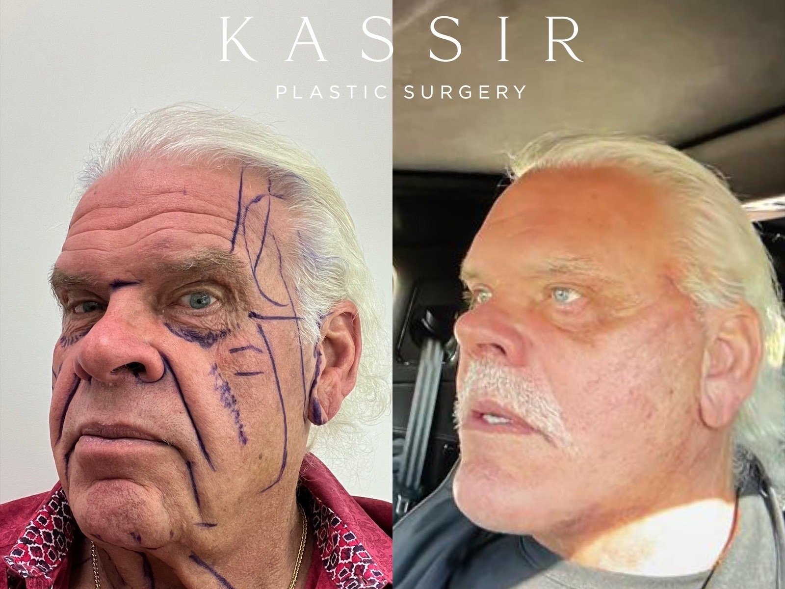 Male Facelift Before and After Gallery — Kassir Plastic Surgery in