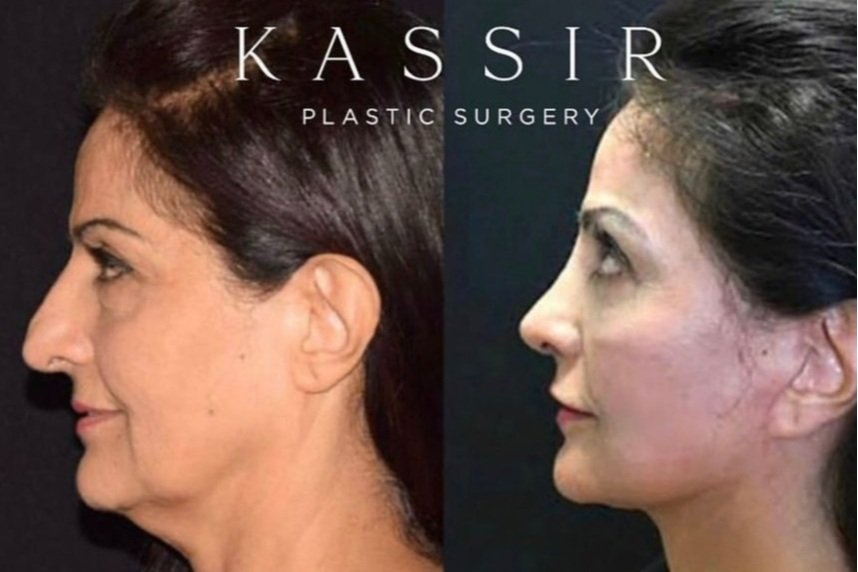 Before and After Deep Plane Facelift and Necklift