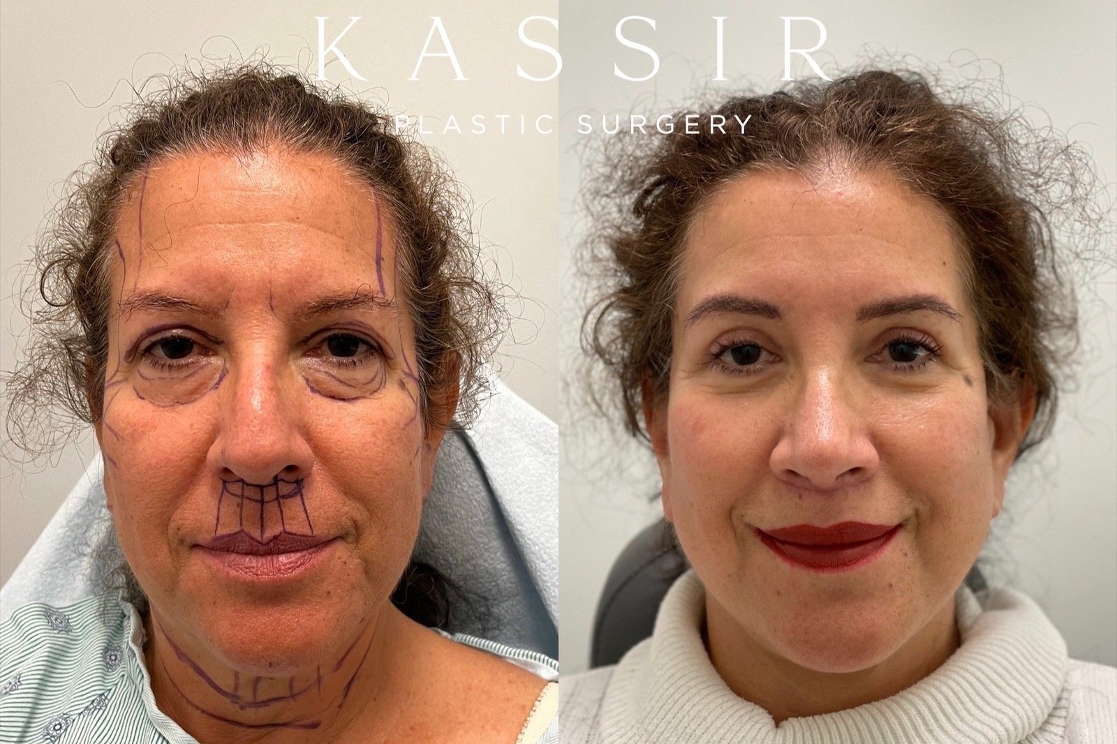 One month after Deep Plane Face and Neck Lift