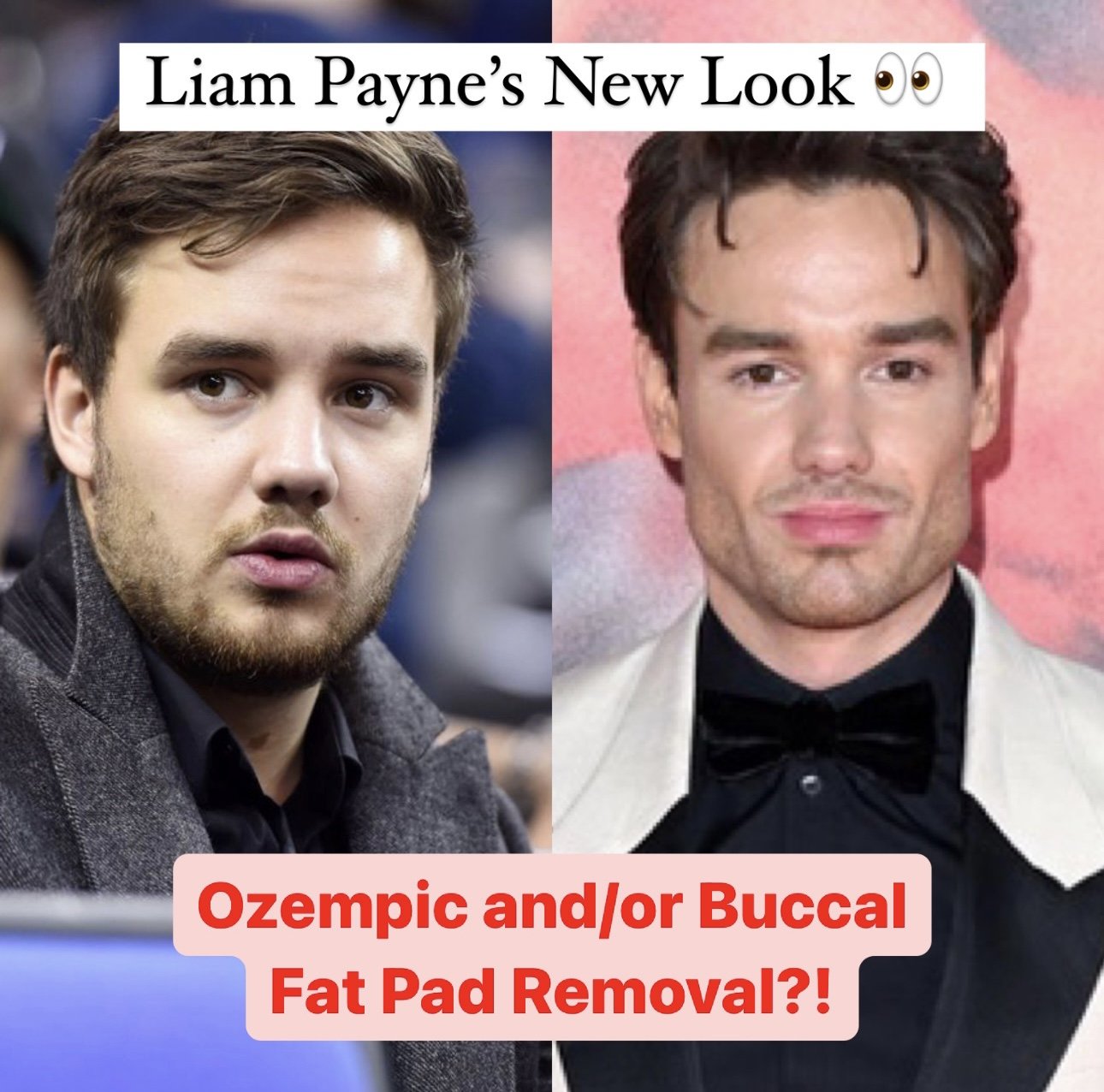 Buccal Fat Pad Removal - Liam Payne Transformation — Kassir Plastic Surgery  in NY and NJ