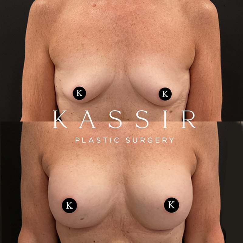 3 months before and after breast augmentation