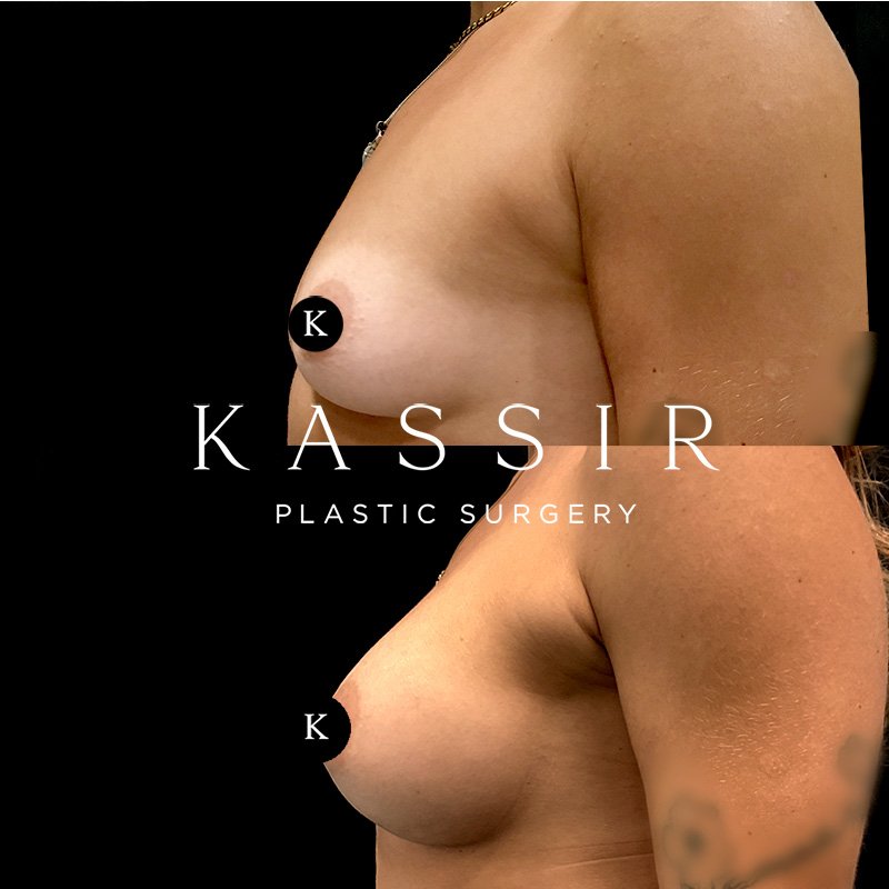 breast2kassirleft.jpg