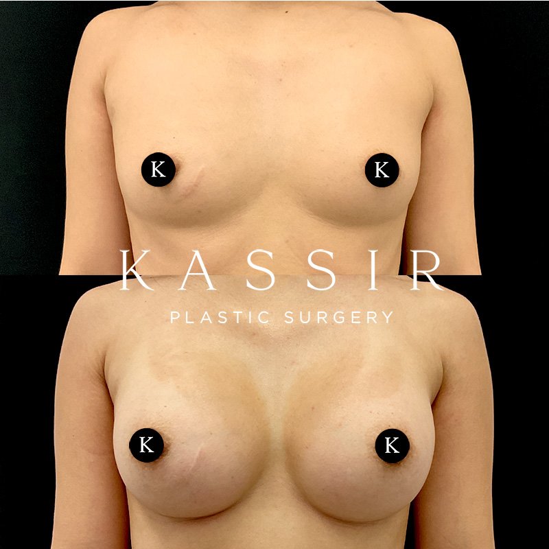 breast3kassirfront.jpg