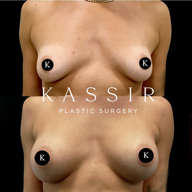 breast2kassirfront.jpg