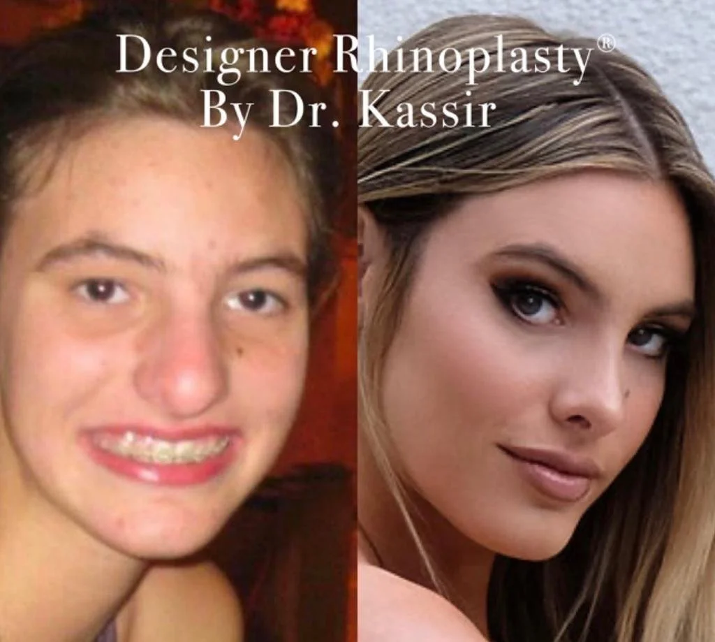 rhinoplasty 111.jpeg