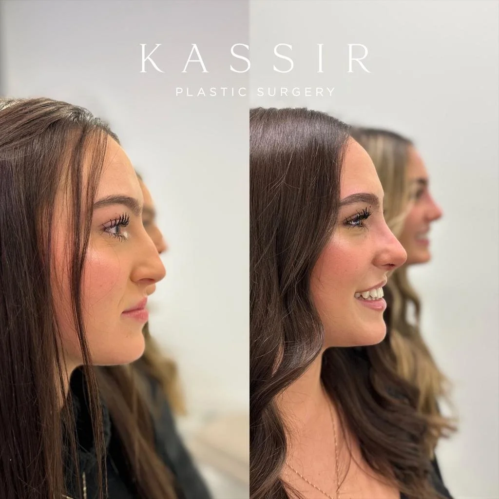 twin rhinoplasty 2.jpeg