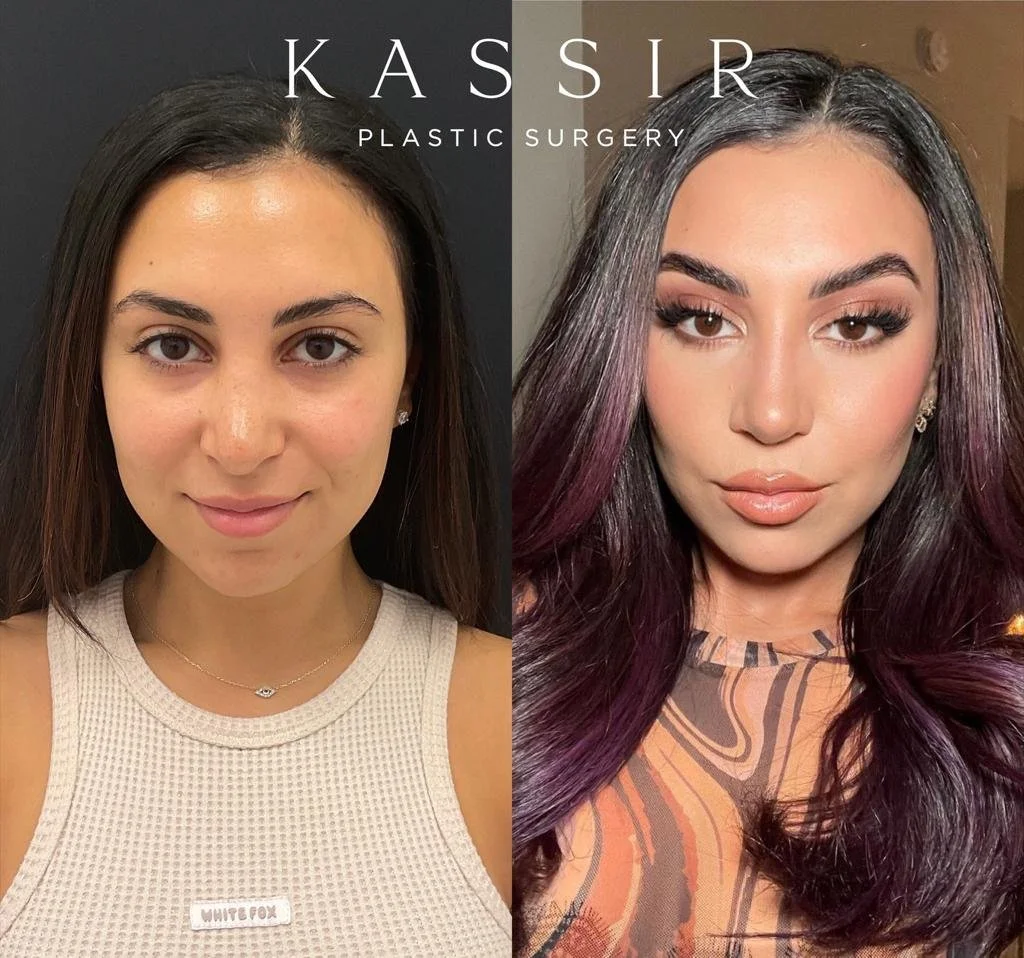 revision rhinoplasty 1.jpeg