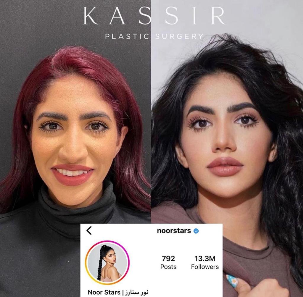 noor stars rhinoplasty 4.jpeg