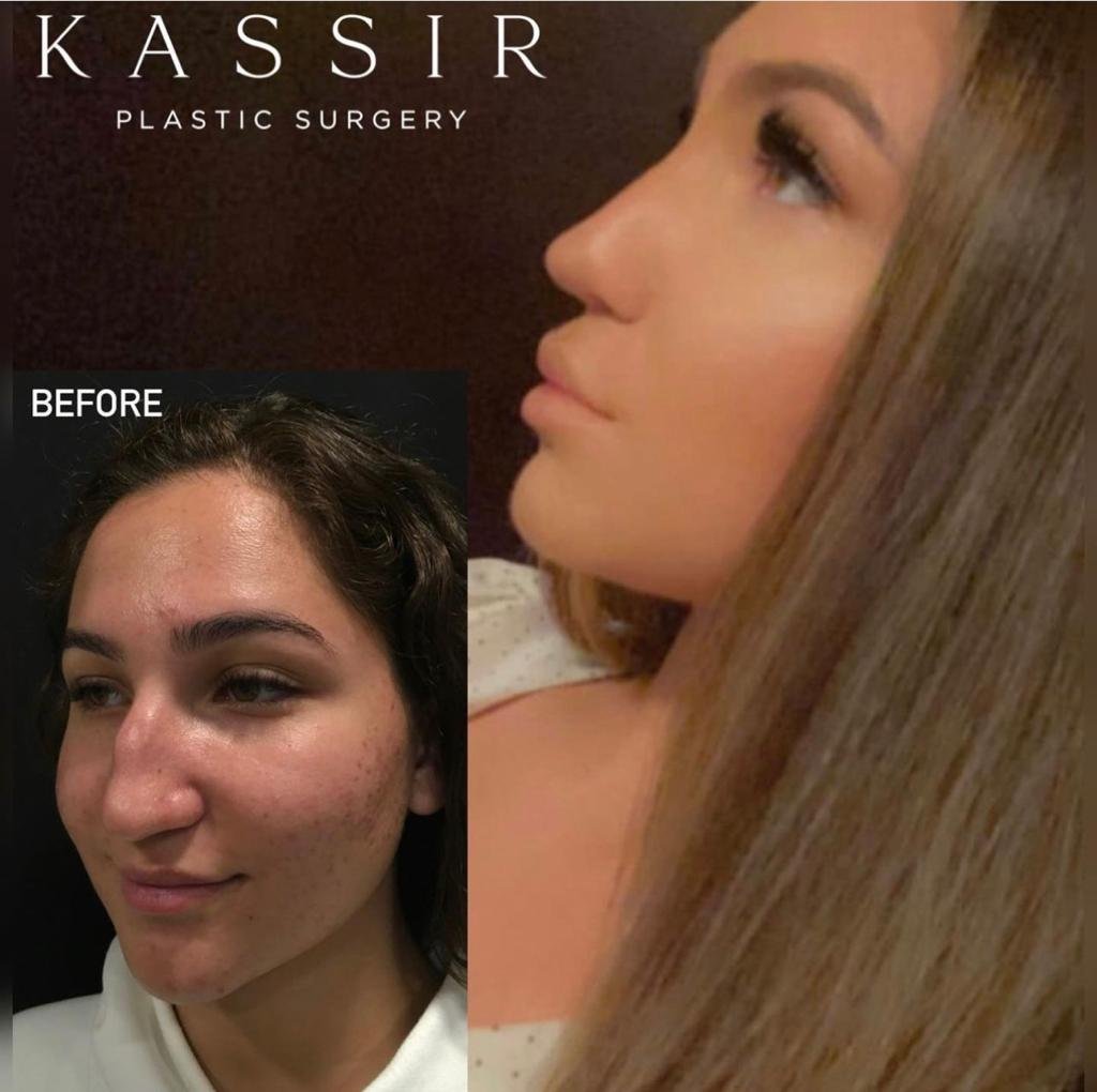 rhinoplasty 801.jpeg