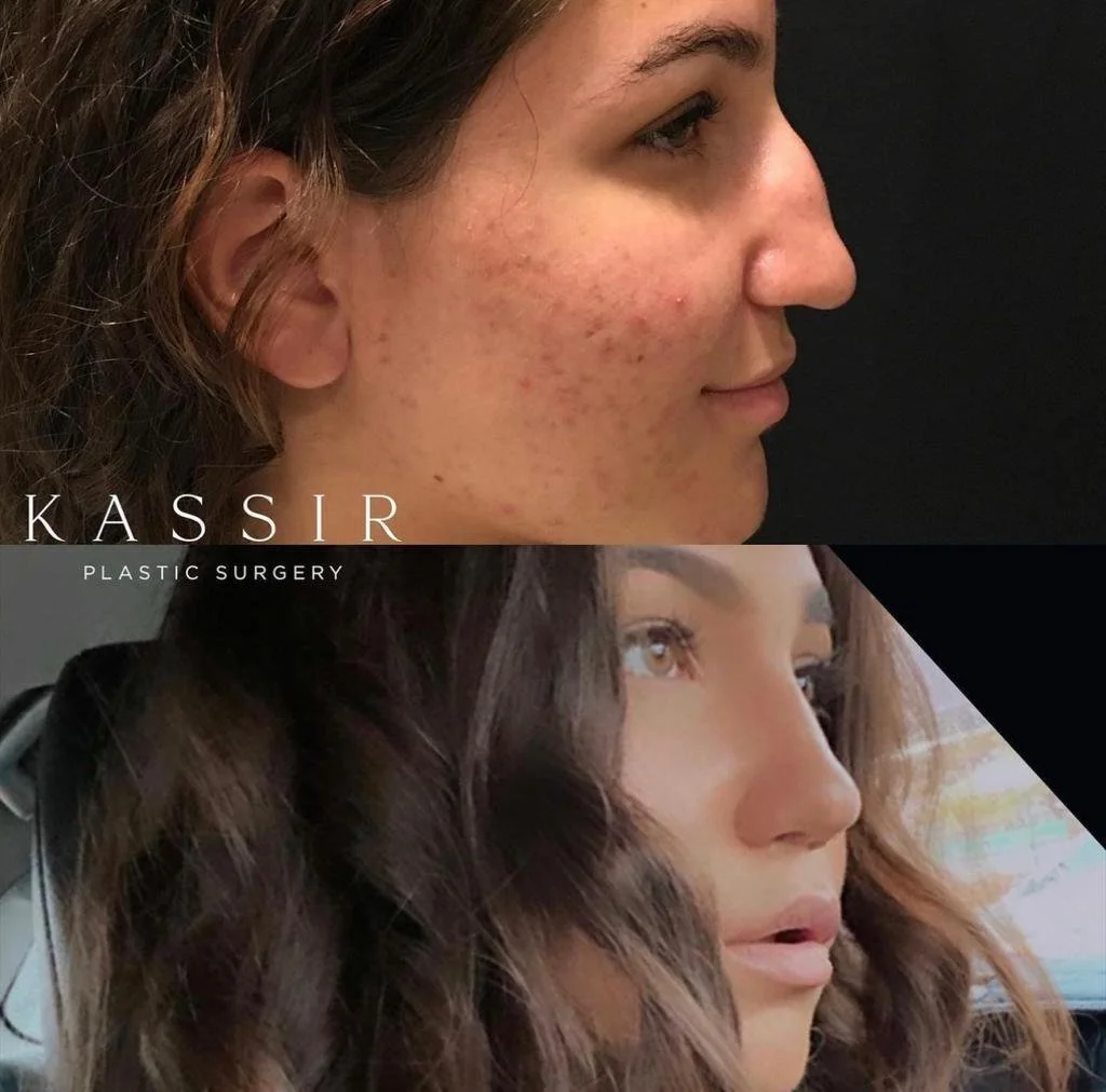 rhinoplasty 805.jpeg