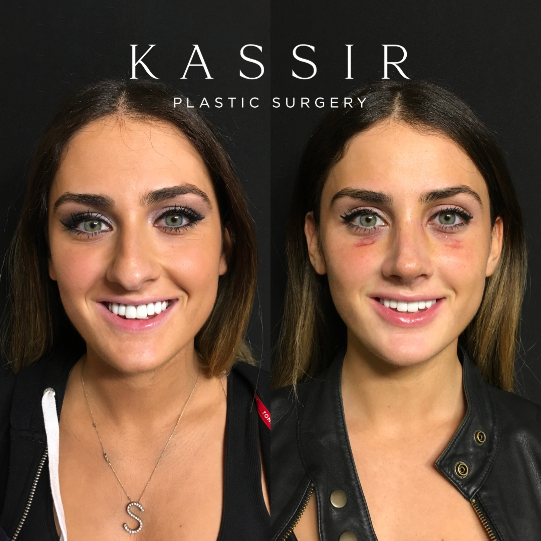 rhinoplasty 31 1.png