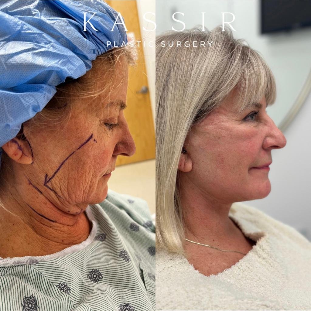 Micro Neck Lift — Dr. Kian