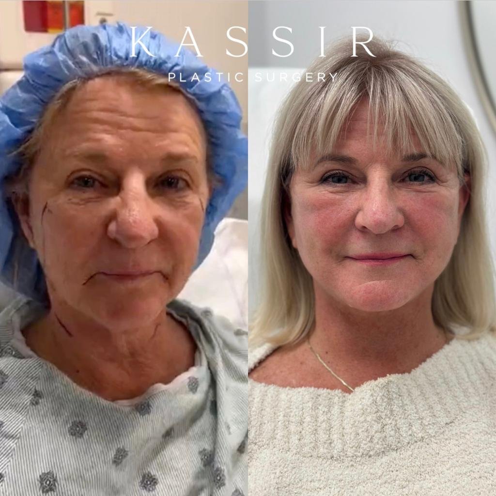 1 month after Revision Face &amp; Neck Lift and CO2 Laser