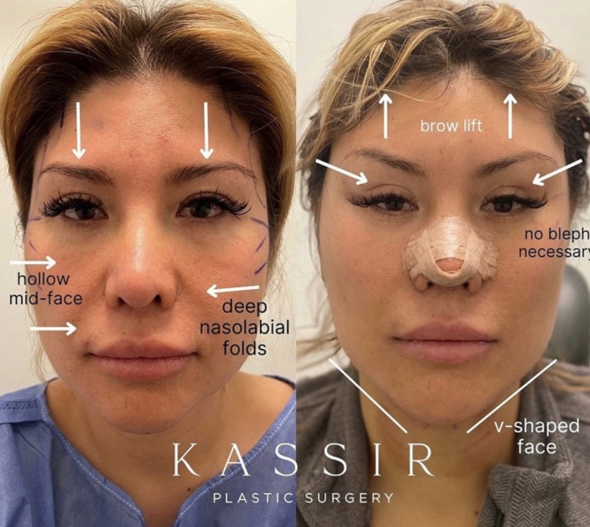 Face & Brow Lift WITHOUT any Scars - One Stitch Lift™ — Kassir