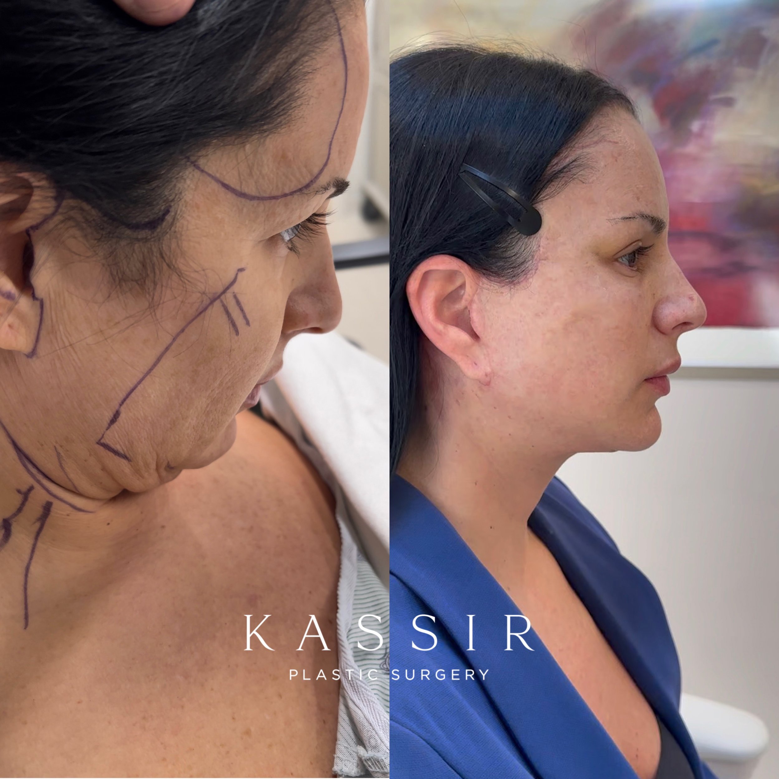 Recovery After a Deep Plane Facelift, Endoscopic Brow Lift and